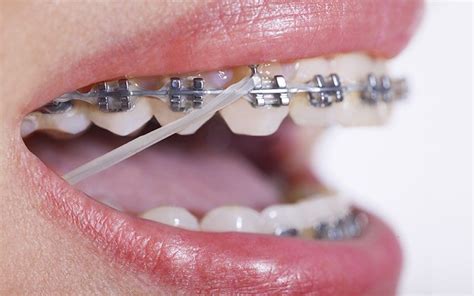 para que sirven las ligaduras metalicas en los brackets|elásticos para brackets.